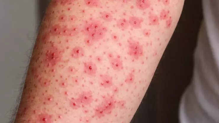 ¡Alerta! Aumentan casos de sarampión ¿Hay riesgo de confinamiento como pasó con el COVID?