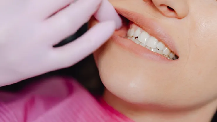 Estos son los alimentos que disminuyen el sarro en los dientes