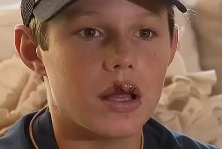 niño es mordido en el labio por tiburón tras estar pescando langostas en florida