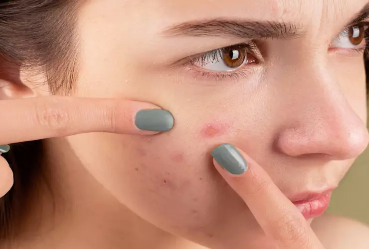 furonculofilia granos videos