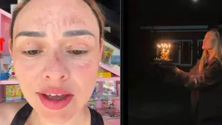 Influencer quemaduras