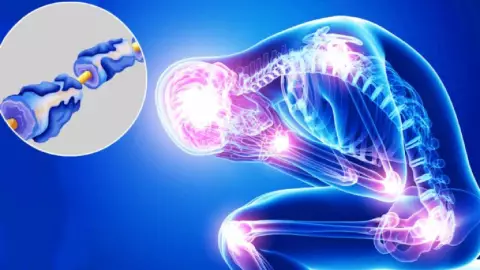 ¿Comiste pollo Reportan aumento de casos del síndrome de Guillain-Barré