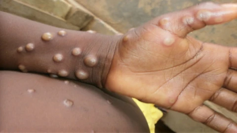 En México se han reportado un total de 53 casos de Mpox de la variante clado II.