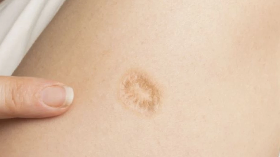 Cicatriz de la primera vacuna 