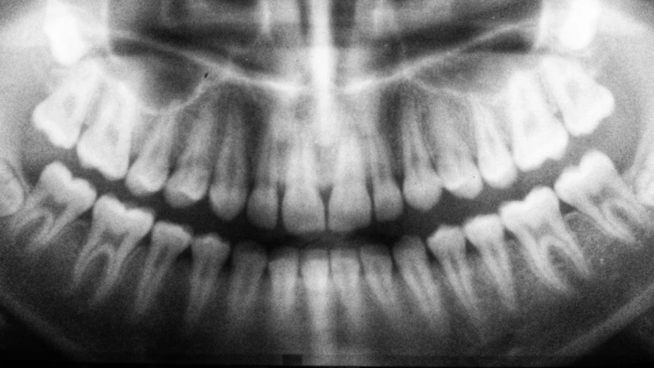 Horror en clínica: niña de 6 años muere por un diente de leche