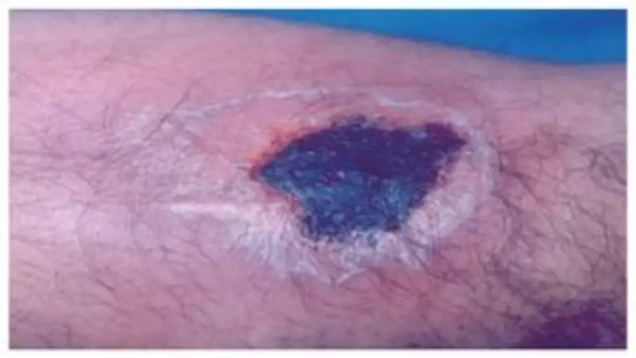 Necrosis por mordedura de araña violinista.jpg