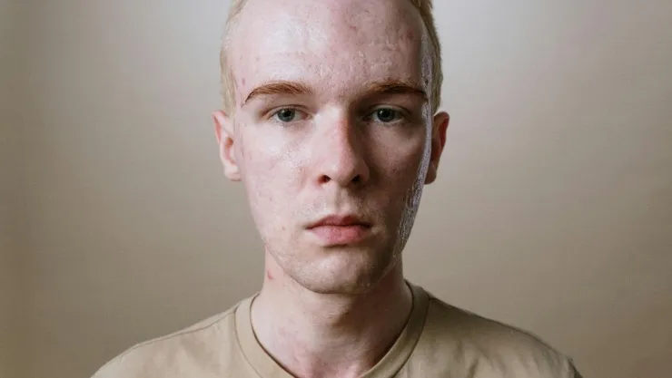 alimentos-podrian-generar-acne-cuerpo.jpg