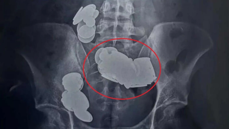 joven se traga monedas e imanes india