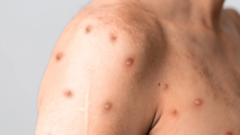 Reportan NUEVO CASO de viruela símica en Yucatán; ya son tres en este 2025