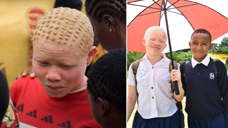 En algunos países, las personas con albinismo mueren por cáncer de piel entre los 30 y 40 años.