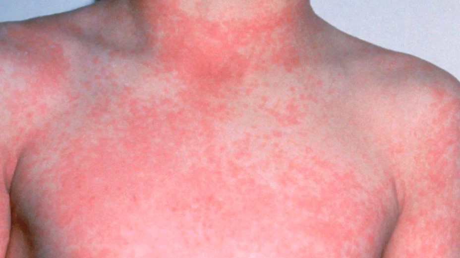 Escarlatina rompe récords en México este 2025: síntomas que debes vigilar