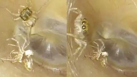 VIDEO: Escucha ruidos raros y acude al médico; tenía una araña en el oído