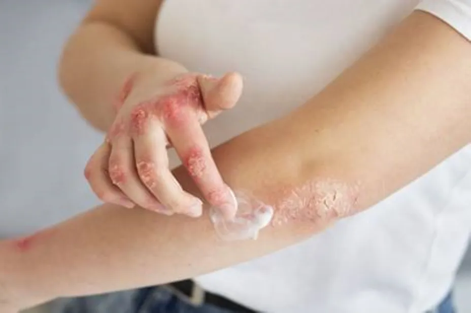 Psoriasis co+co OKI.jpg