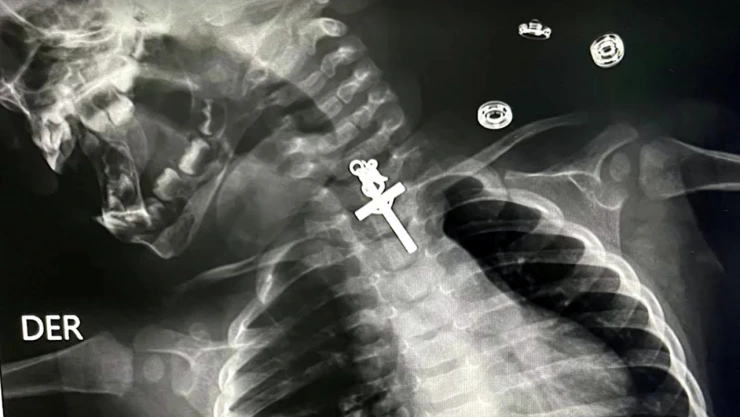 En Perú, bebé de 10 meses de traga un crucifijo por accidente
