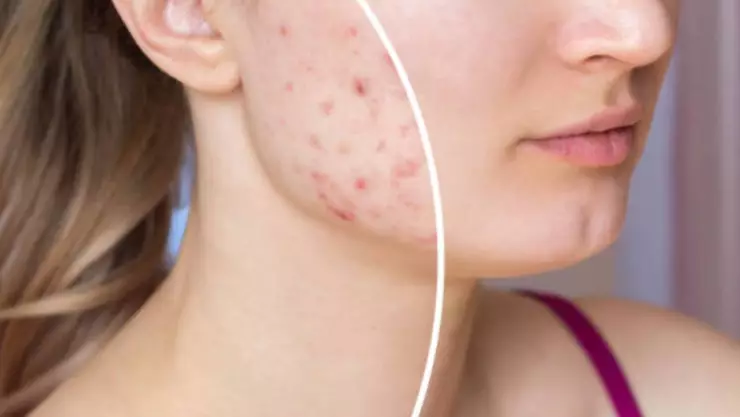 ¿Solución para el acné? Científicos crean tratamiento para reducir la inflamación