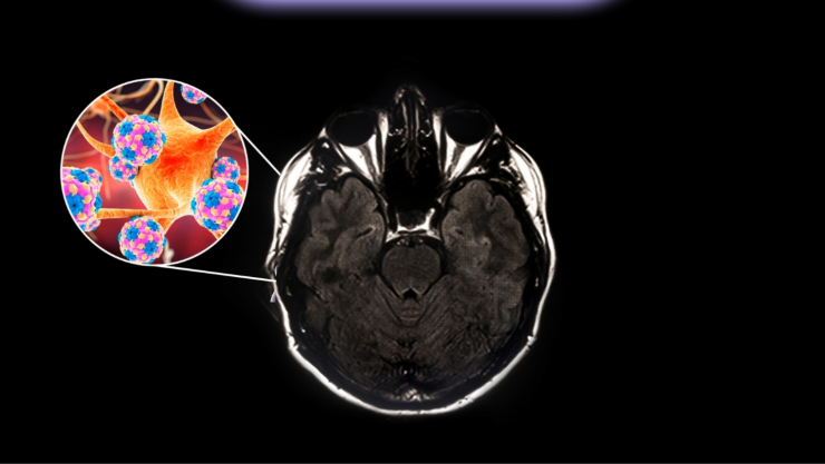 Qué es la meningitis bacteriana y cómo se transmite.