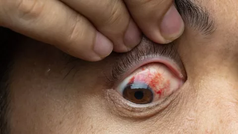 Los motivos detrás de la ceguera causada por el sarampión