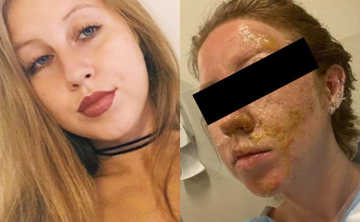 VIDEO: Meseros queman el rostro de una turista en un bar de Cancún