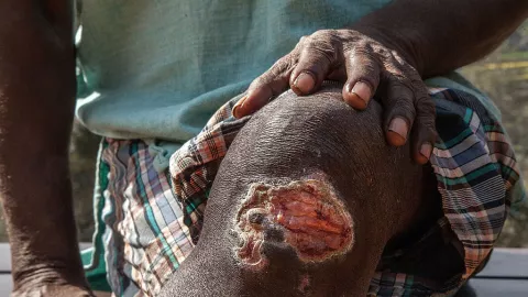 Nuevo caso de lepra en Quintana Roo; suman 90 en México