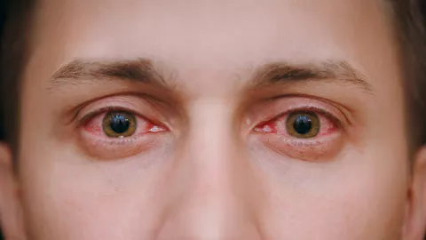 Ojos Rojos
