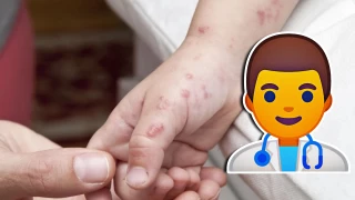 ¿Qué es el virus Coxsackie y cómo afecta a los menores de edad_ Aquí te decimos cómo prevenirla y los síntomas.jpg