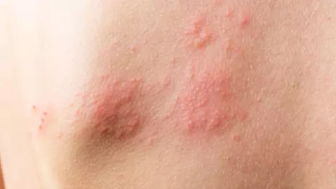 ¿Qué diferencias hay entre viruela del mono y la varicela