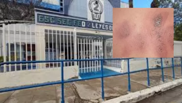 ataque con sosa cáustica a estudiante de secundaria