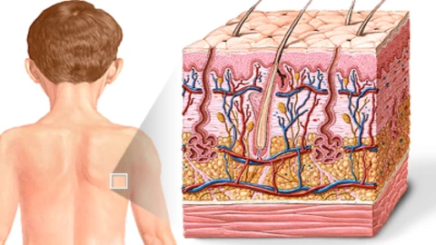 Quemaduras: tipos, causas y tratamiento adecuado