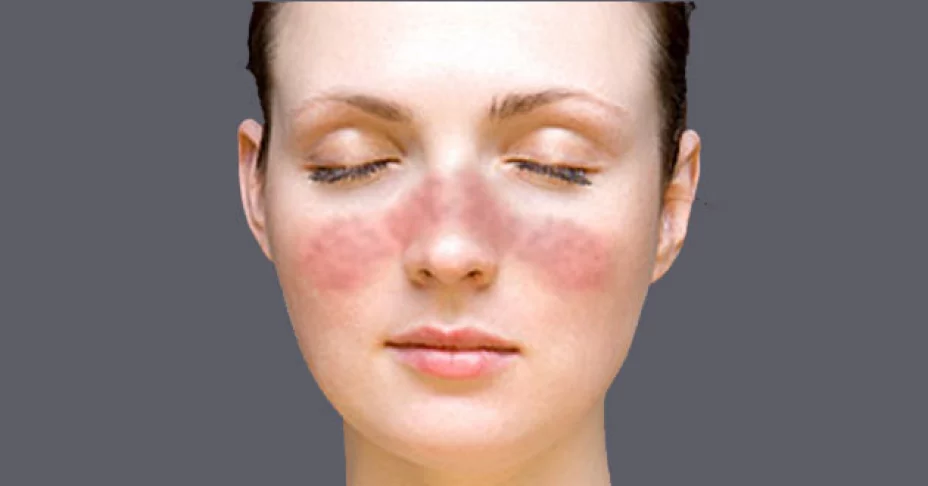 Lupus eritematoso afecta principalmente a mujeres