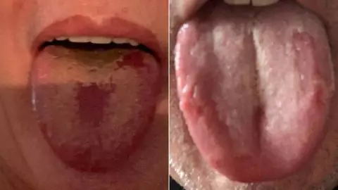 La ‘lengua COVID’ es el nuevo síntoma detectado en los enfermos de COVID-19