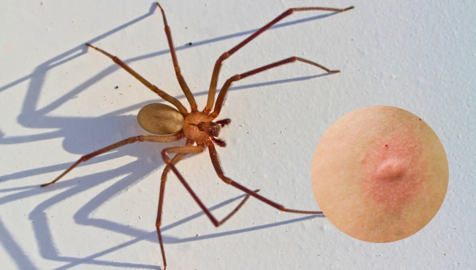 síntomas de piquete de araña violinista