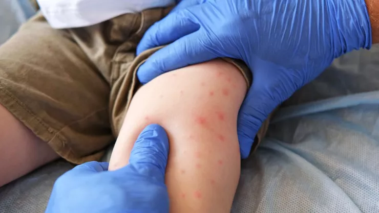 Dos casos sospechosos de sarampión en guardería del IMSS en CDMX