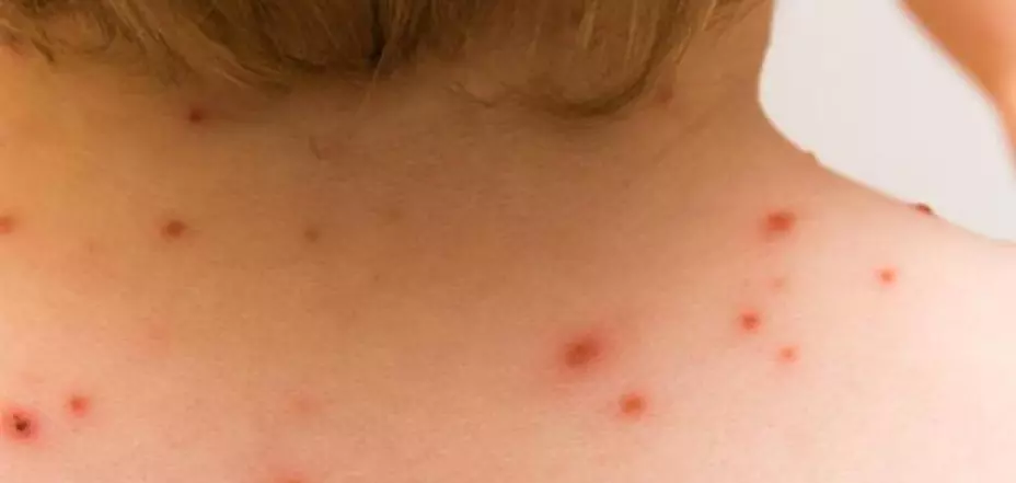 ¿Cómo prevenir el contagio de la viruela del mono