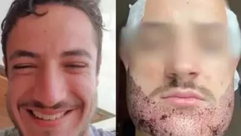 trasplante de barba fallido