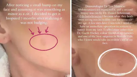 Khloé Kardashian le extirpan un tumor en su rostro,.jpg