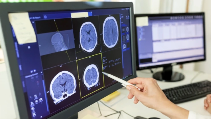 Cerebro de los asesinos seriales
