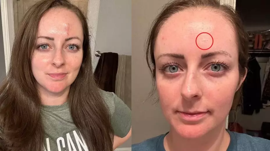 ¡Cuidado con ese ‘grano’! La historia de Cera Byrum y el cáncer de piel