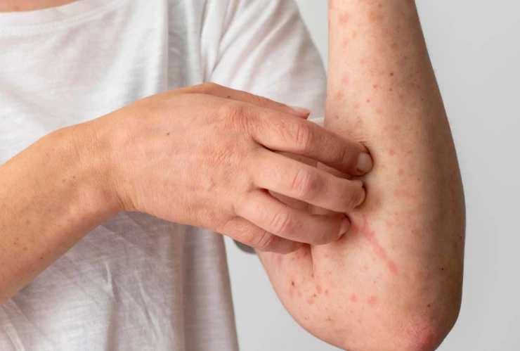 donde aplican vacunas gratis sarampión CDMX