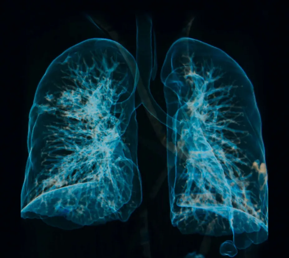 EPOC pulmones.jpg