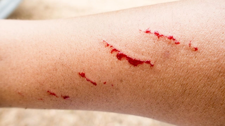 Caso de rabia en Zacatecas tras mordedura de animal silvestre