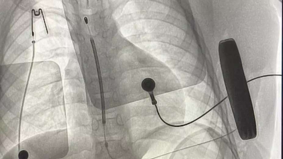 IMSS niño arritmias