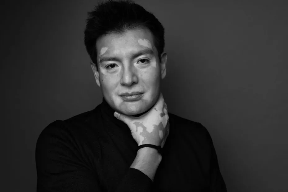 Vitiligo Funda OK.jpg