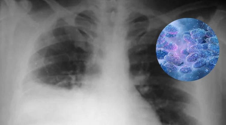 Radiografía de la peste neumónica y síntomas