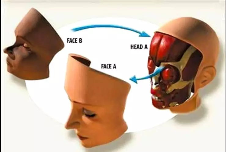 Hospital de Boston realiza trasplante de rostro