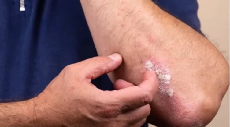 Fumar-desarrolla-riesgo-psoriasis-tabaco