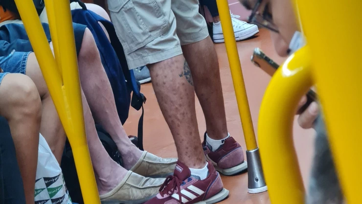 Caso viruela del mono en metro.jpg