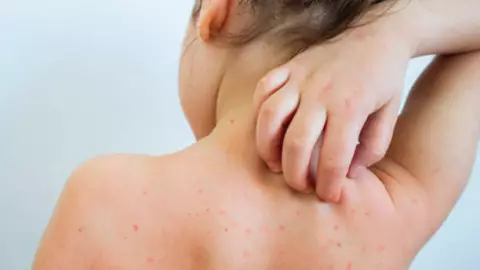 Repuntan casos de varicela en México, Jalisco con más contagios