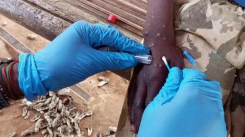 Viruela del mono en Querétaro: ¿cuántos casos se han registrado en Querétaro?