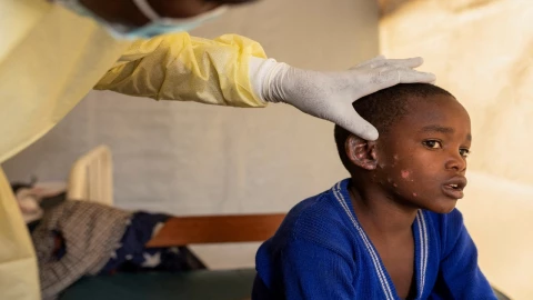 México-refuerza-vigilancia-ante-brotes-de-viruela-del-mono-en-África