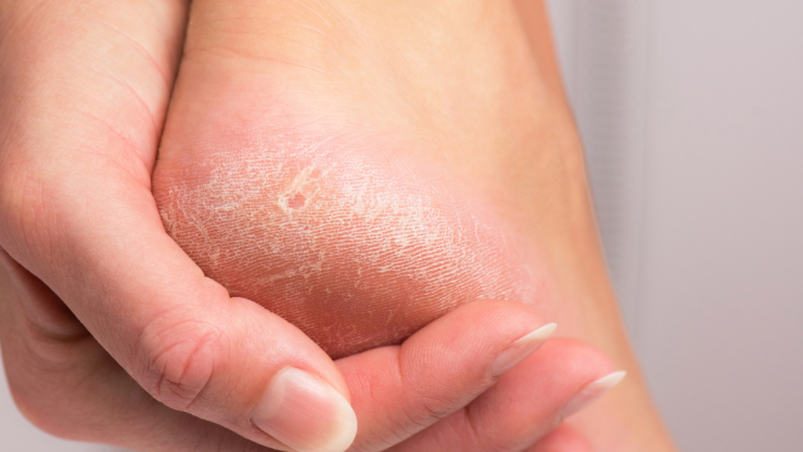 Sequedad en los pies